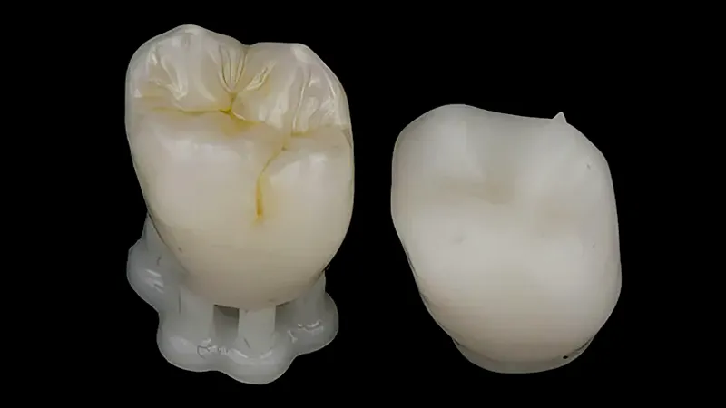 Partial Dental Crowns Partial Dental Crowns