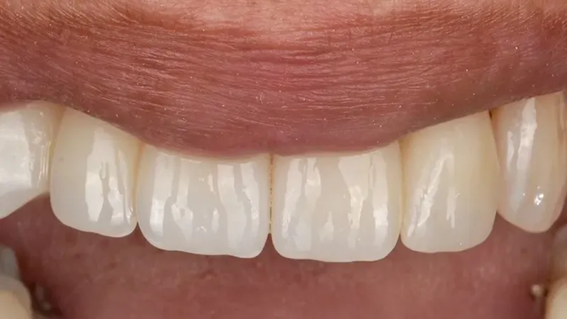 Multi-Layer Zirconia Restorations Multi-Layer Zirconia Restorations